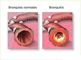 bronquitis